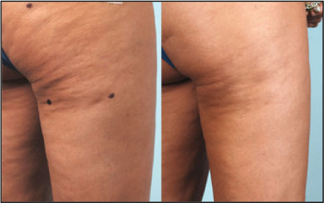 before and after Cellulaze